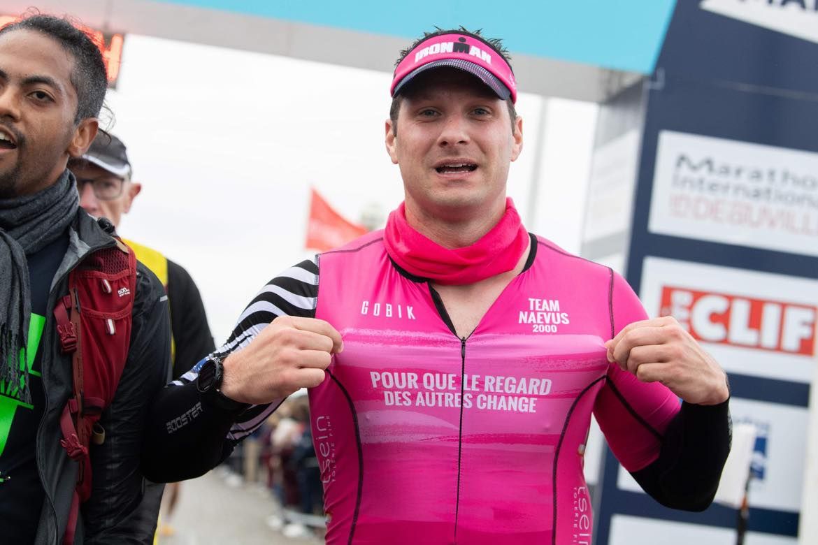 Naevus géant : association naevus 2000